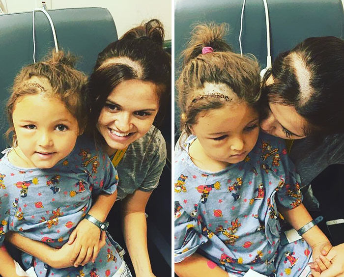 Elle se rase les cheveux pour soutenir sa fille après une chirurgie cérébrale !